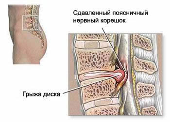 osteochondrosis spine treatment